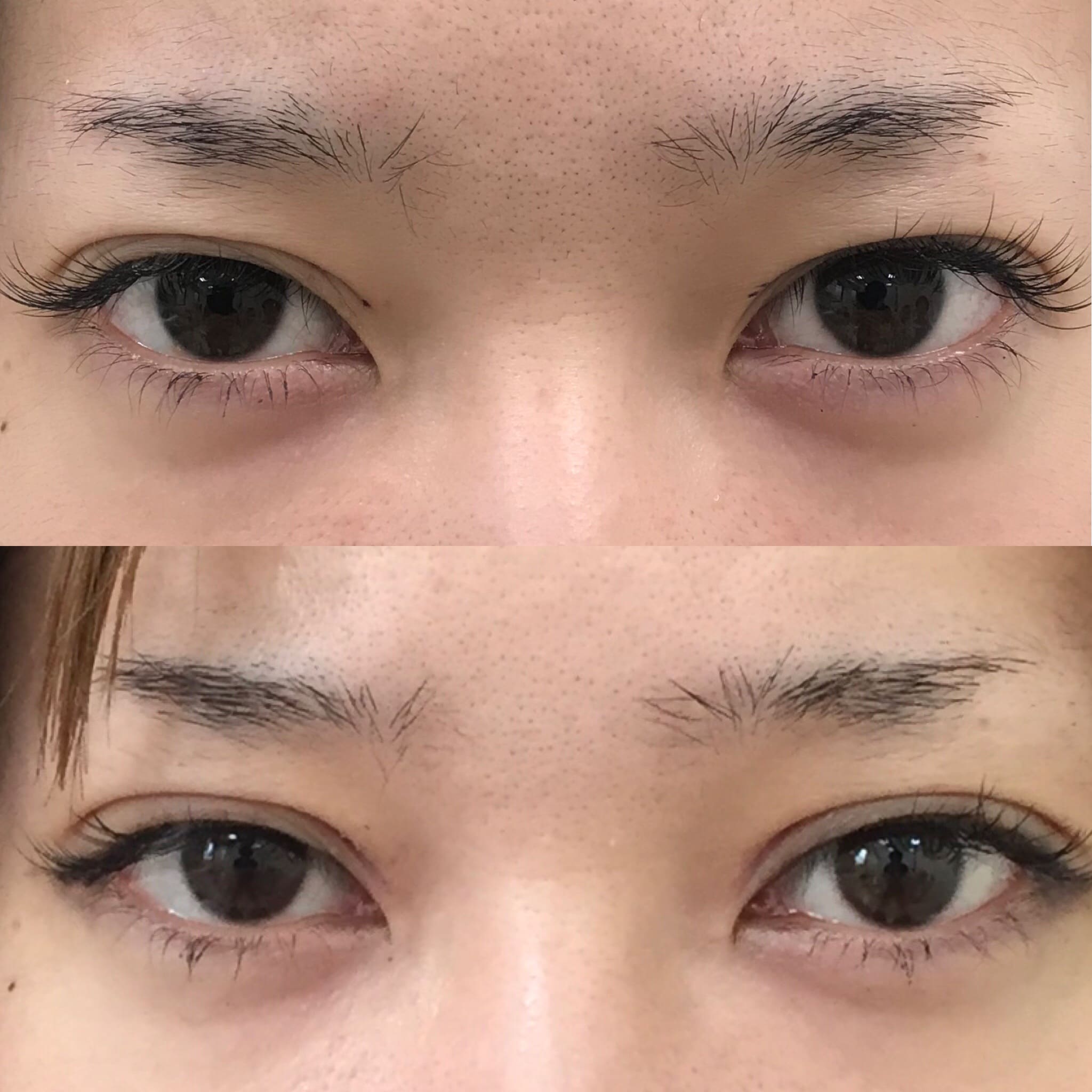 二重切開法比較