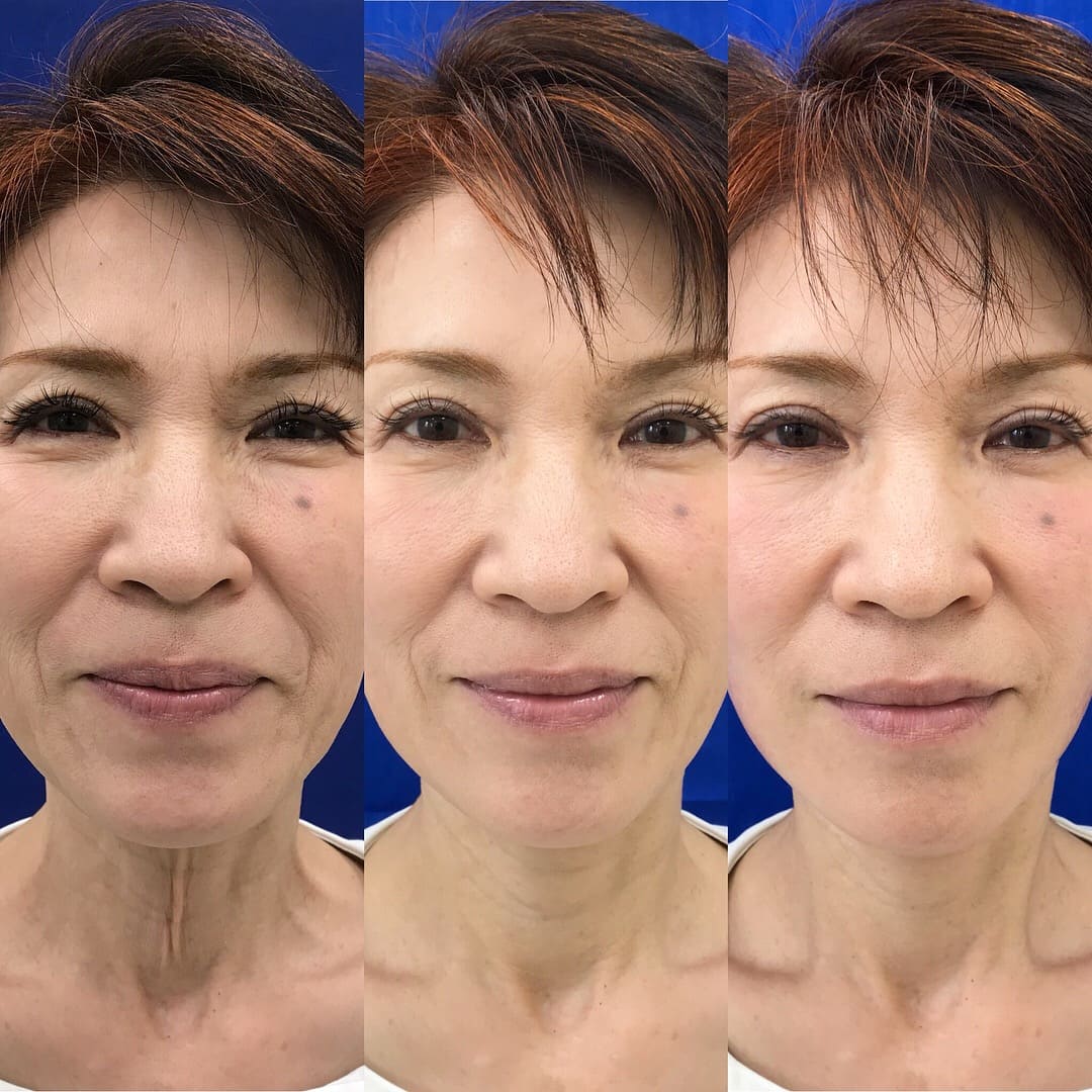たるみの症例まとめ