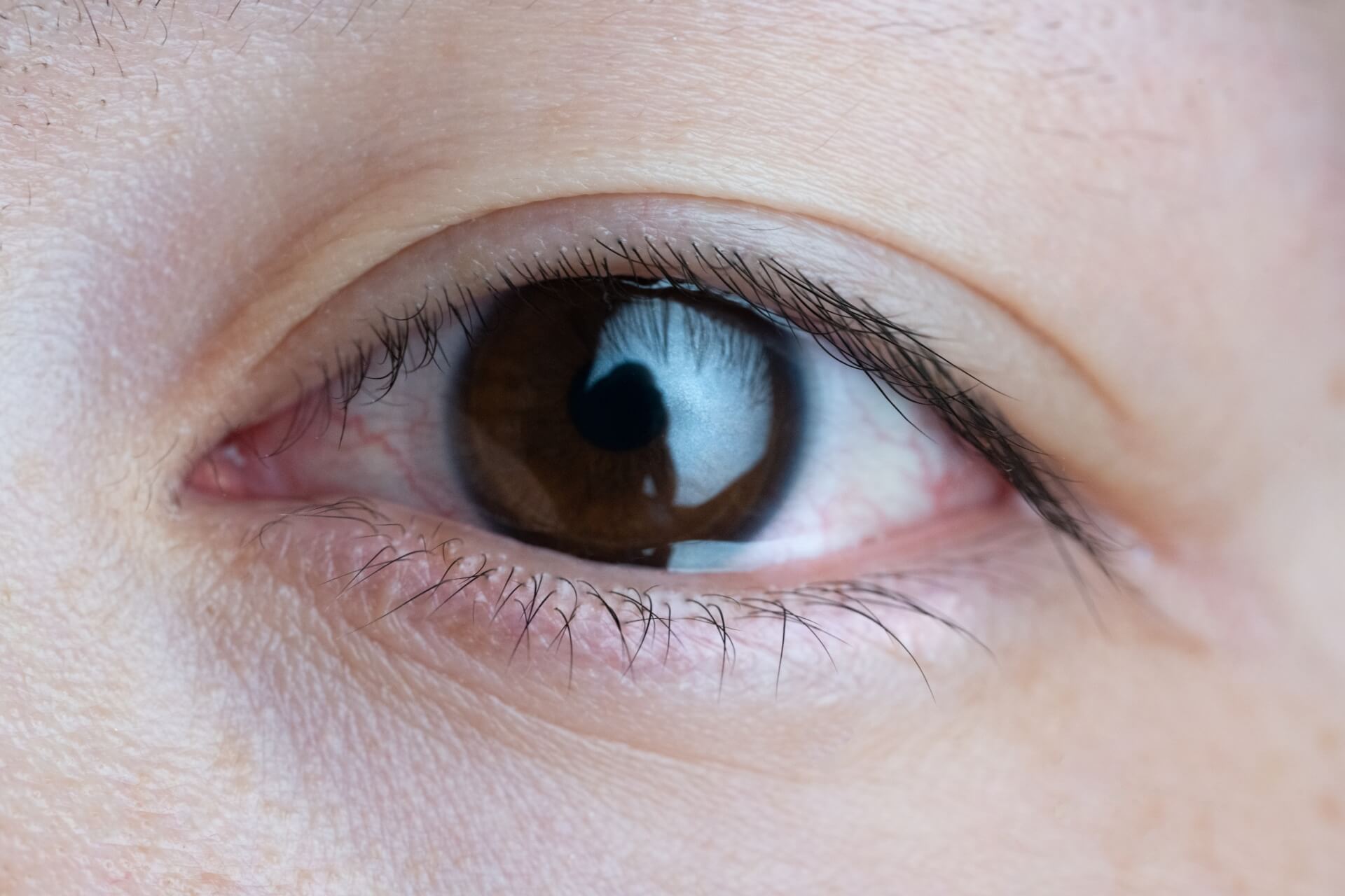 全切開と埋没法の違いは？