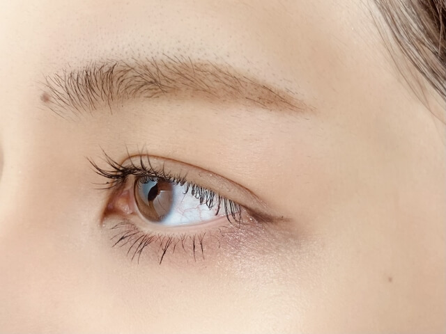 眼瞼下垂の全切開法と治療のポイント