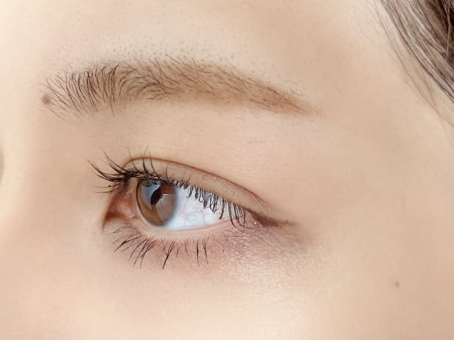 全切開法による二重術とは？